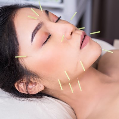 Acupuncture Photo